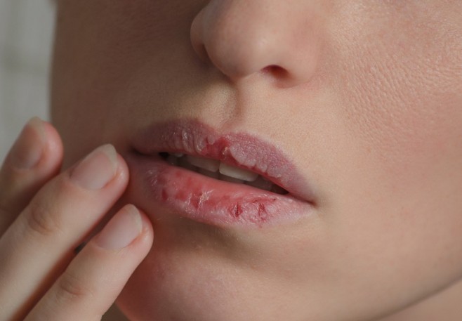 Comment expliquer le phénomène des lèvres gercées ?